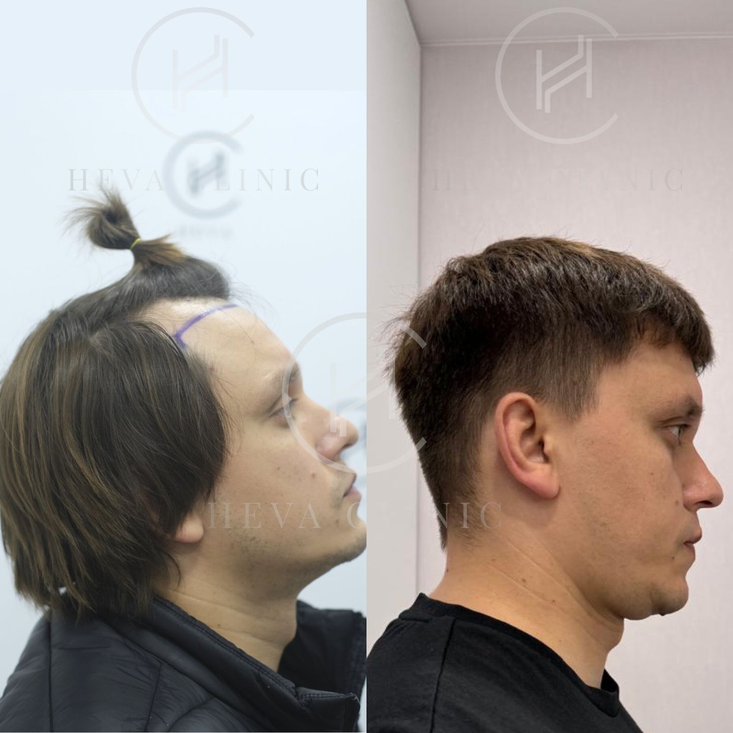 20 Best Men s Haircuts For Balding Hair How To Hide Your Hair Loss 20 Best Men s Haircuts For Balding Hair How To Hide Your Hair Loss