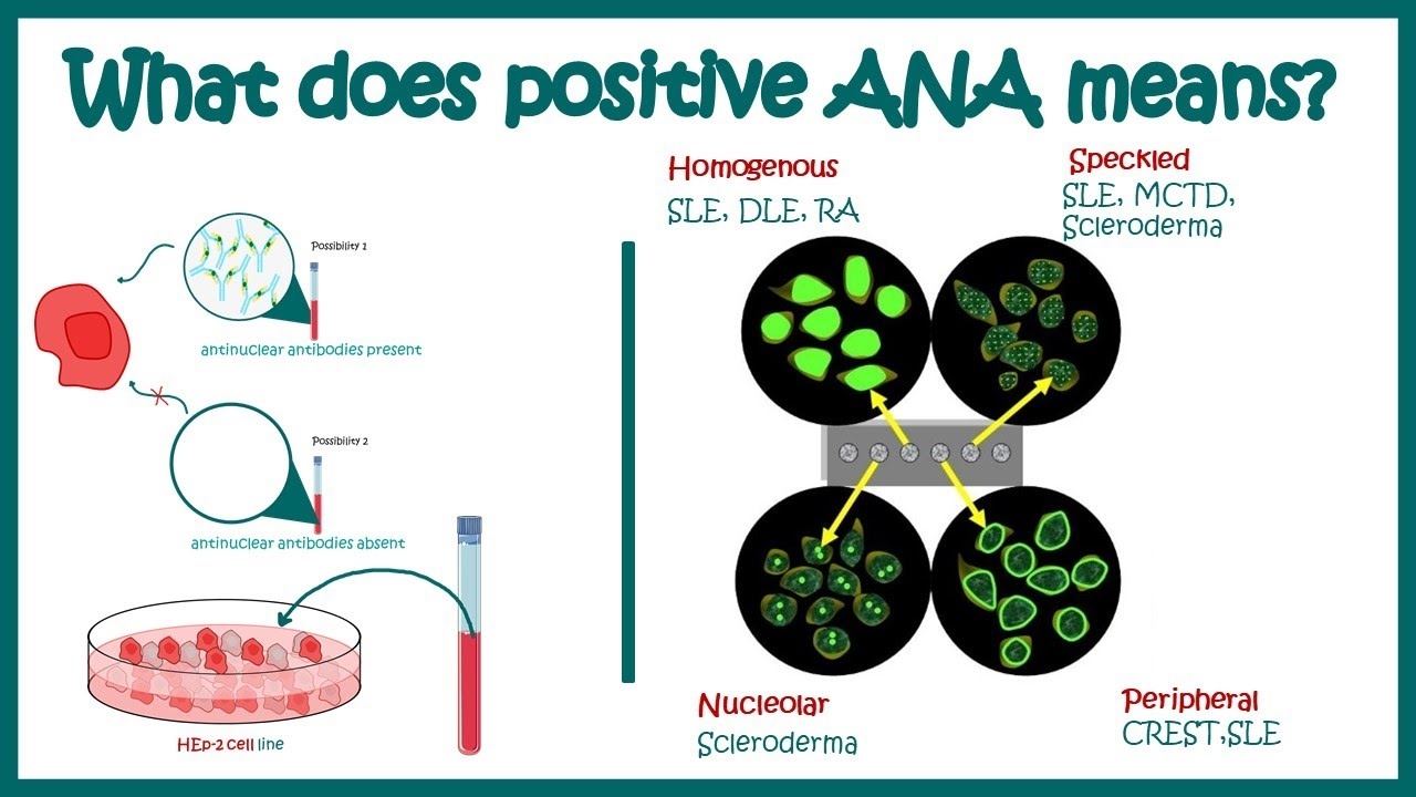 Antinuclear Antibodies ANA Test And Their Patterns ANA Test What Does ANA Test Positive Mean YouTube Antinuclear Antibodies ANA Test And Their Patterns ANA Test What Does ANA Test Positive Mean YouTube