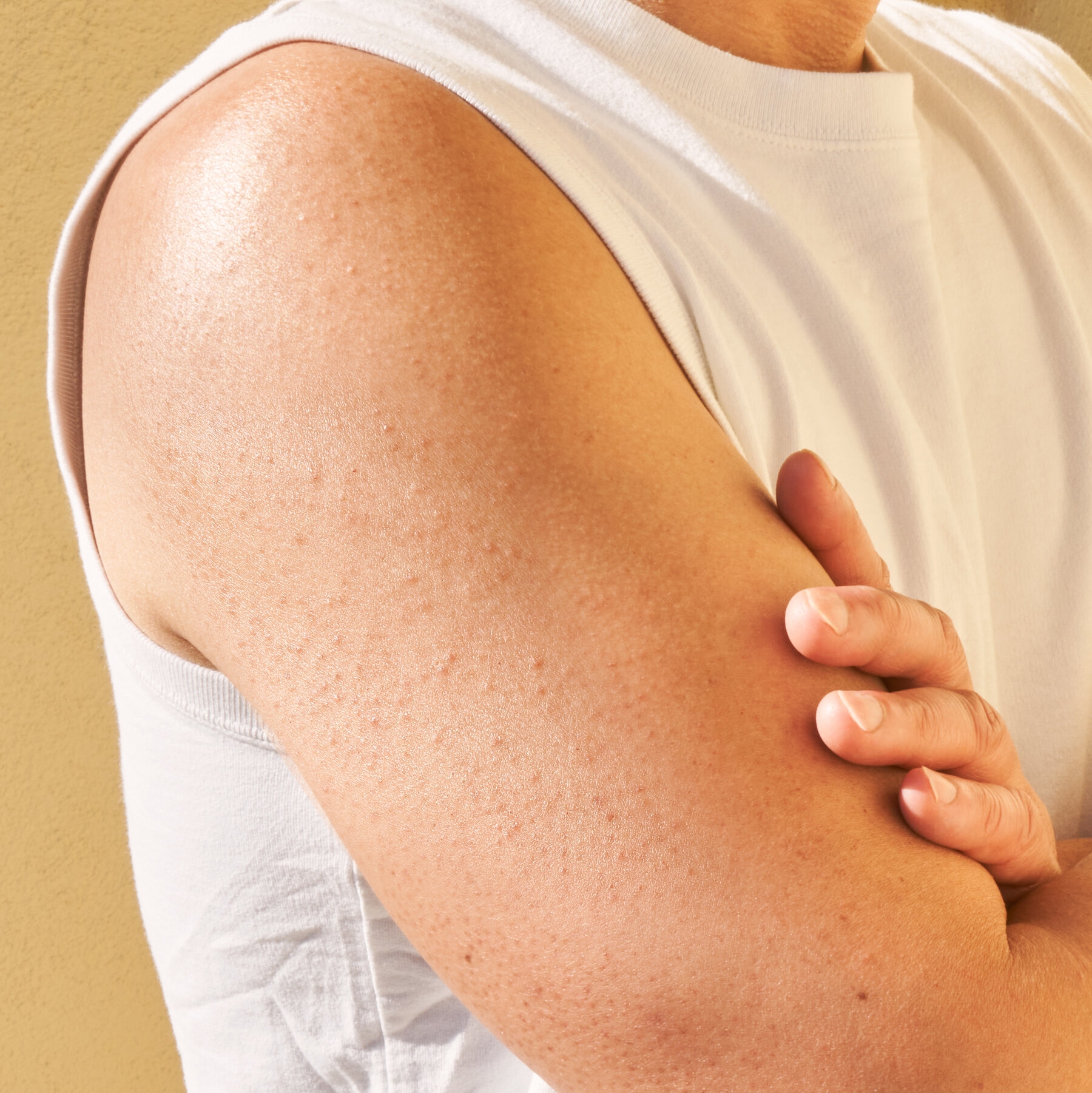 How Do I Get Rid Of The Chicken Skin On My Arms And Legs The New York Times How Do I Get Rid Of The Chicken Skin On My Arms And Legs The New York Times