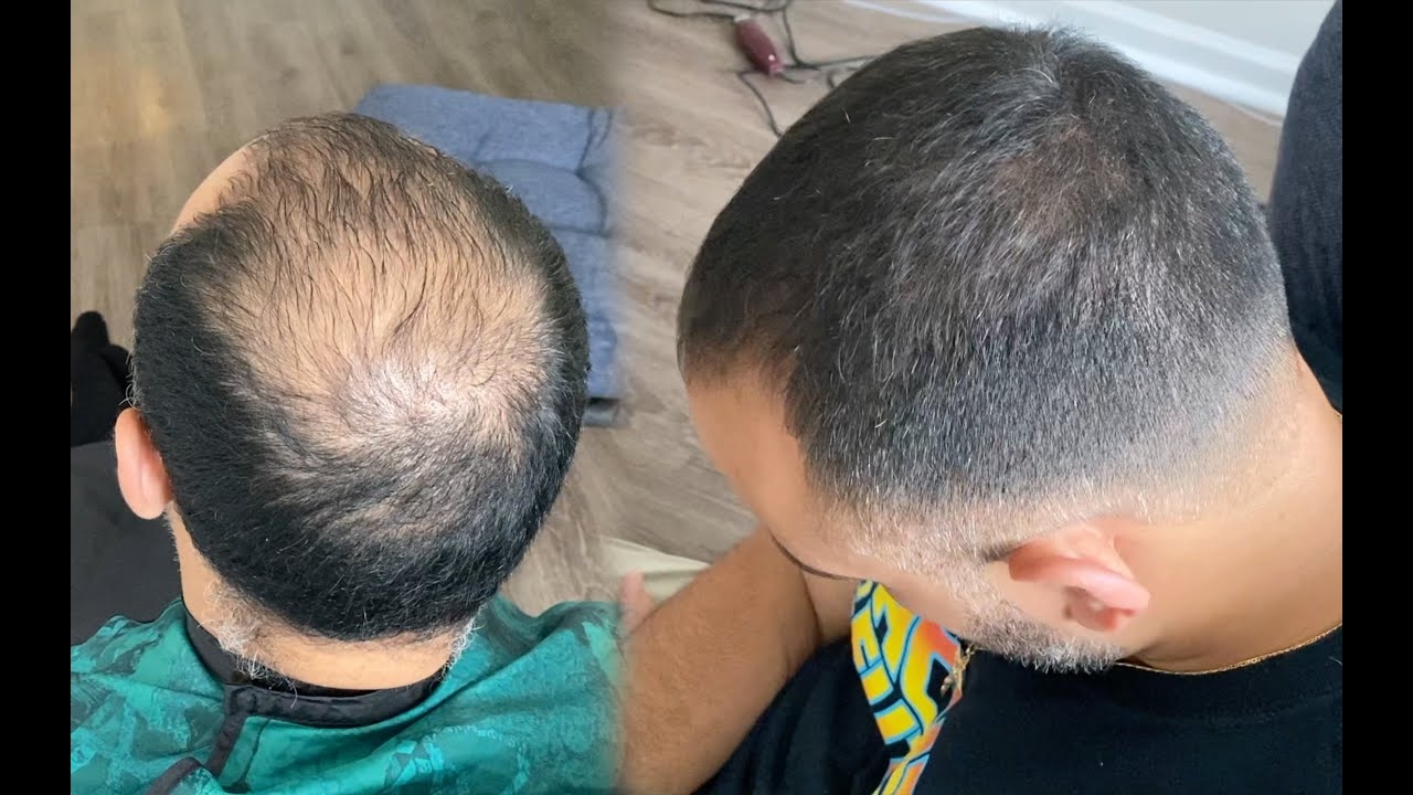 MAJOR Transformation How To Fade Balding Hair Apply Hair Fibers YouTube MAJOR Transformation How To Fade Balding Hair Apply Hair Fibers YouTube