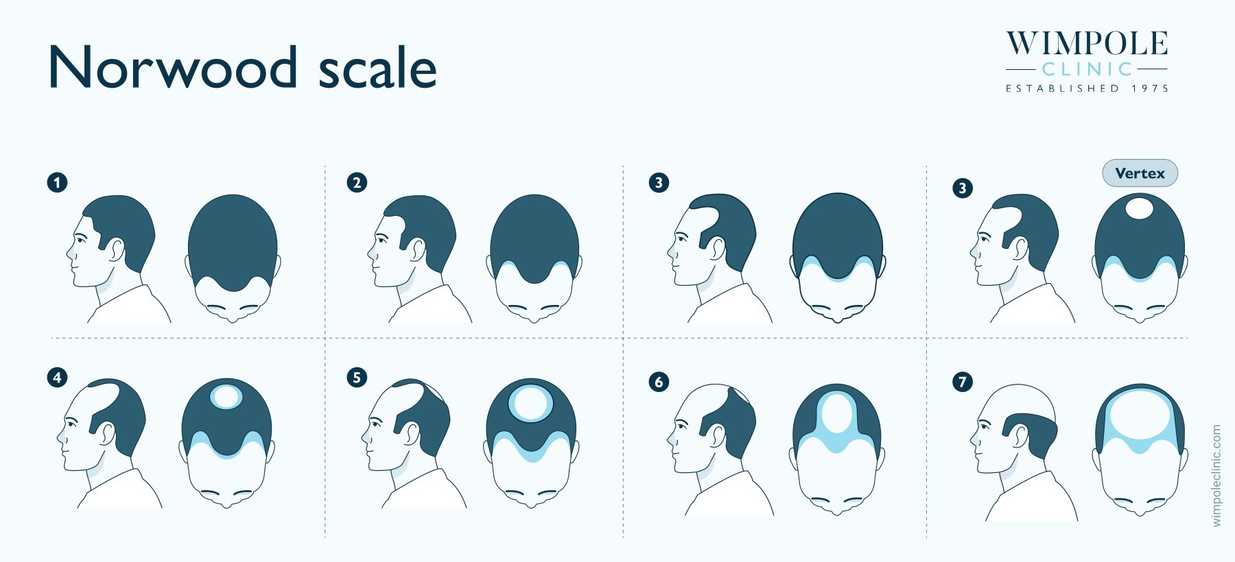 Male Pattern Baldness Causes Stages Treatment Options Male Pattern Baldness Causes Stages Treatment Options