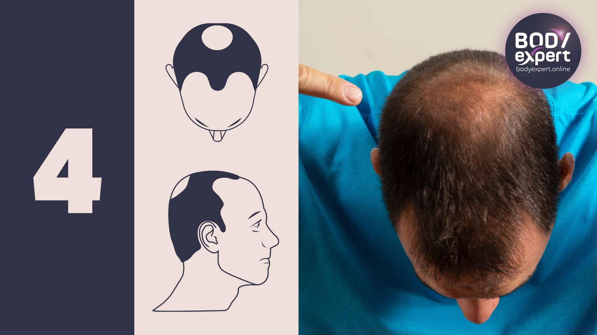 male pattern baldness stages male pattern baldness stages