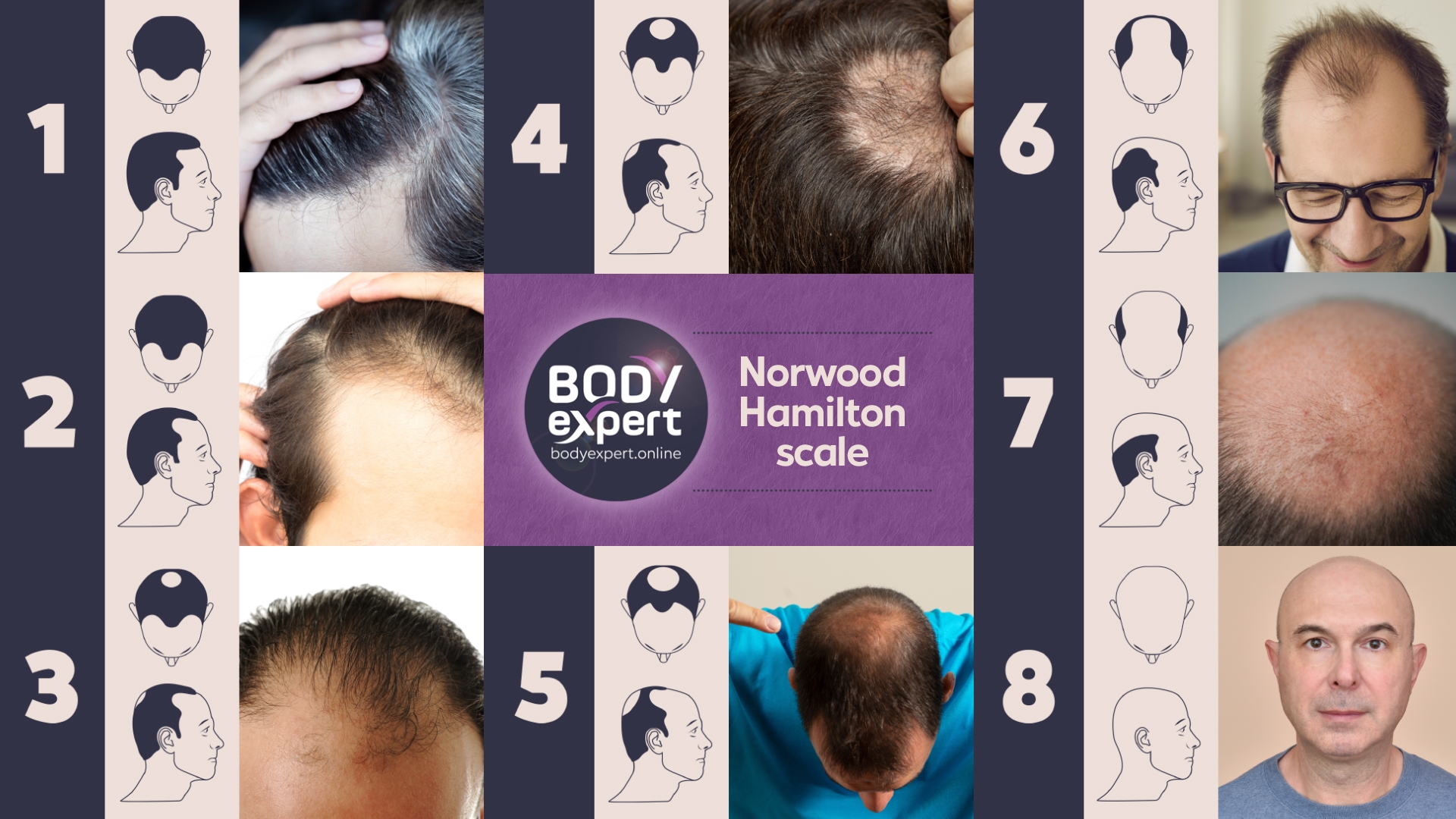 Norwood Hamilton Scale The 7 Stages Of Male Pattern Baldness Norwood Hamilton Scale The 7 Stages Of Male Pattern Baldness