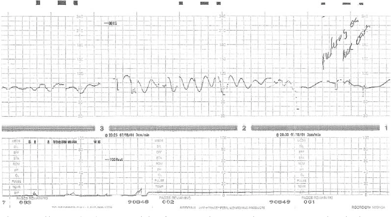 sinusoidal fetal heart rate pattern sinusoidal fetal heart rate pattern