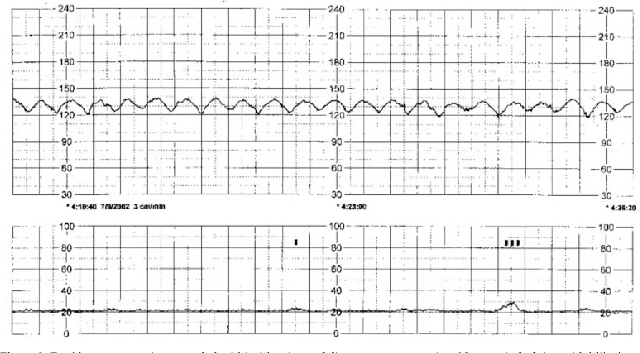 PDF Title Sinusoidal Heart Rate Pattern Reappraisal Of Its Definition And Clinical Significance Semantic Scholar PDF Title Sinusoidal Heart Rate Pattern Reappraisal Of Its Definition And Clinical Significance Semantic Scholar