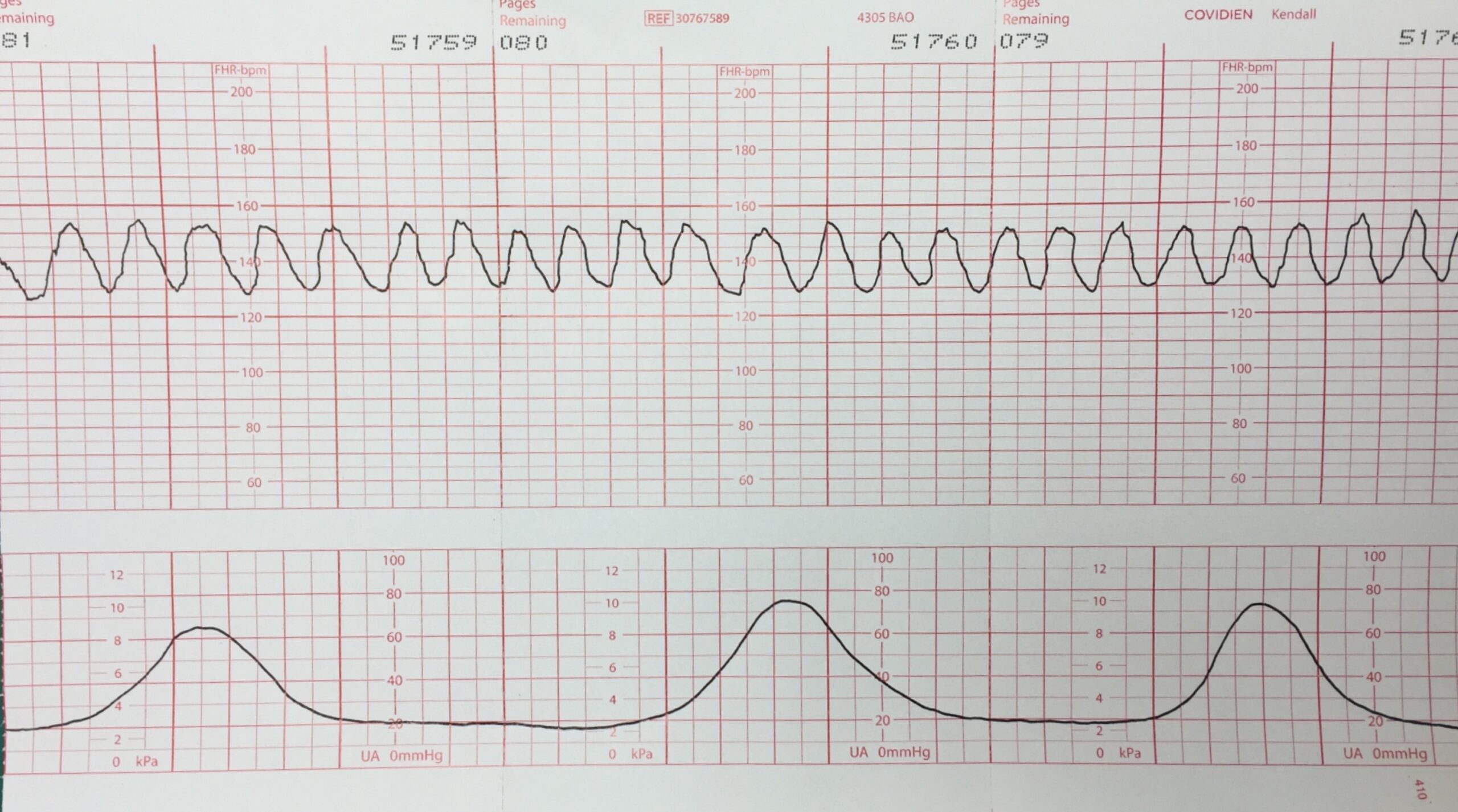 Sinusoidal Pattern Military Obstetrics Gynecology 3rd Edition Sinusoidal Pattern Military Obstetrics Gynecology 3rd Edition