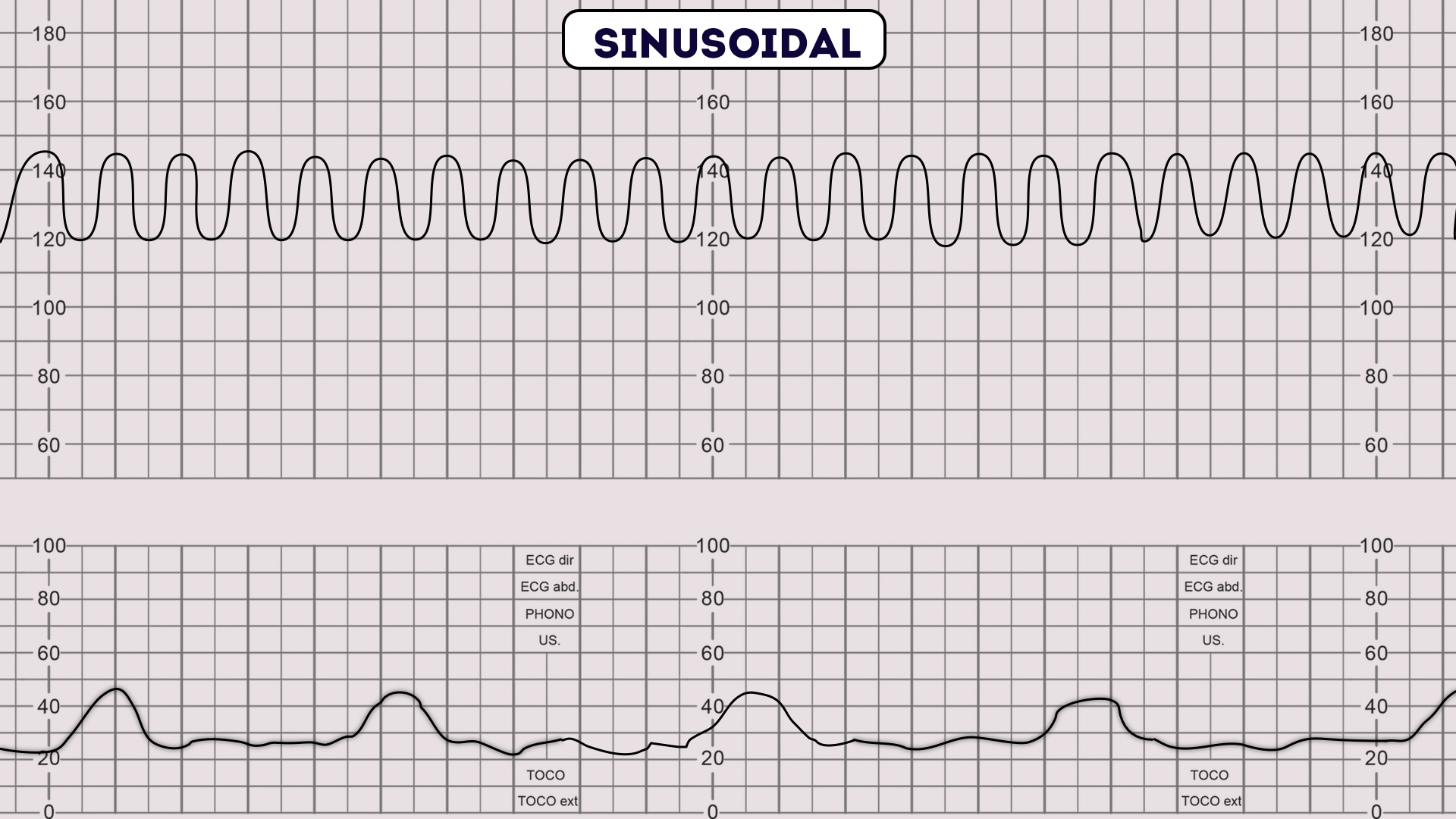 Sinusoidal Pattern On Fetal Heart Tracing Sinusoidal Pattern On Fetal Heart Tracing