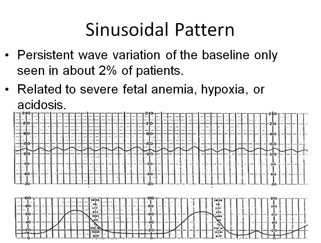 Sinusoidal Pattern On Fetal Heart Tracing Sinusoidal Pattern On Fetal Heart Tracing