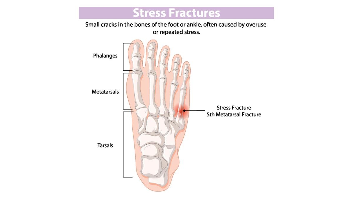 Stress Fractures Symptoms Causes Diagnosis Treatment Los Angeles Times Stress Fractures Symptoms Causes Diagnosis Treatment Los Angeles Times